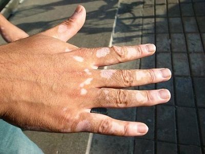 临夏看白癜风专科医院分析手指关节长白斑是白癜风吗？